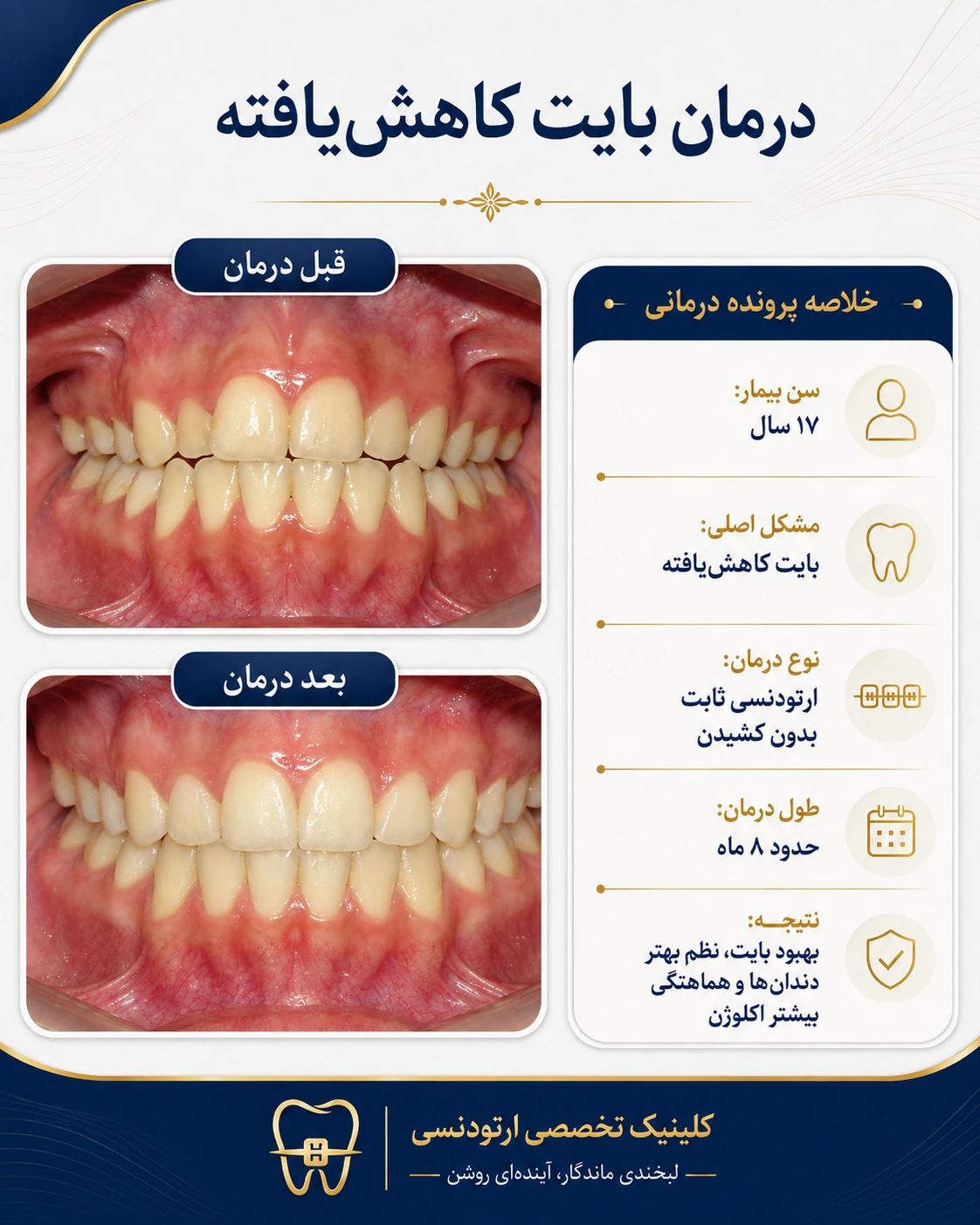 درمان بایت کاهش‌یافته با ارتودنسی ثابت
