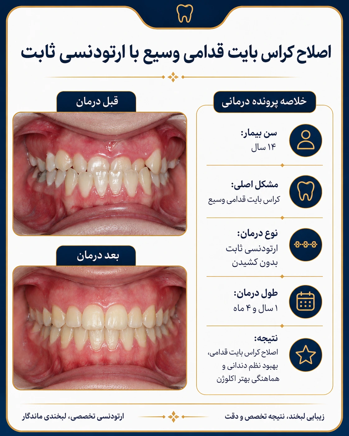 اصلاح کراس‌بایت قدامی وسیع با ارتودنسی ثابت؛ تصویر قبل و بعد درمان