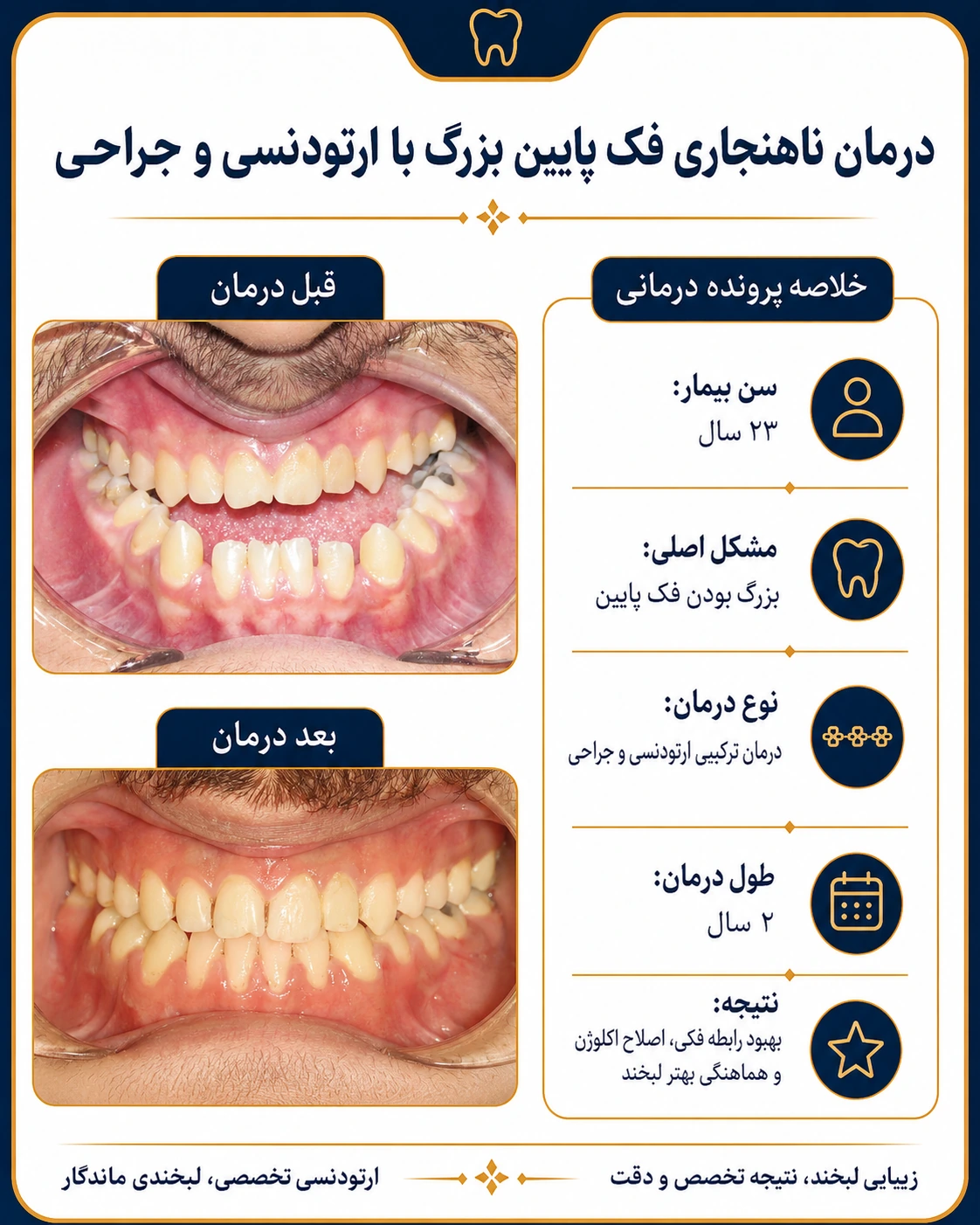 درمان ناهنجاری فک پایین با ارتودنسی و جراحی؛ تصویر قبل و بعد درمان